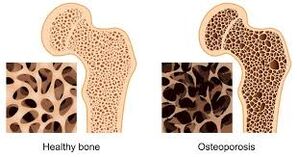 Knochen Osteoporose
